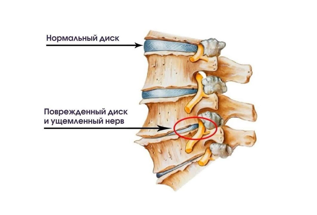 Symptome einer Hals -Osteochondrose