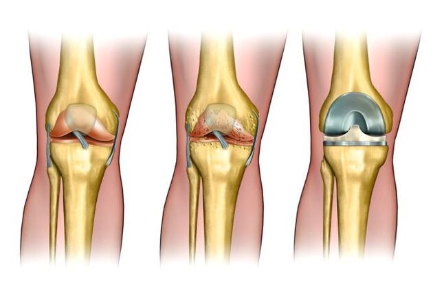 Grad der Arthrose