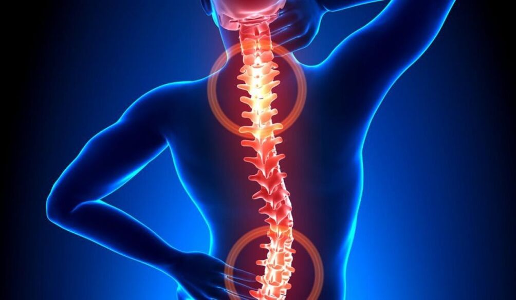 Osteochondrose der Wirbelsäule
