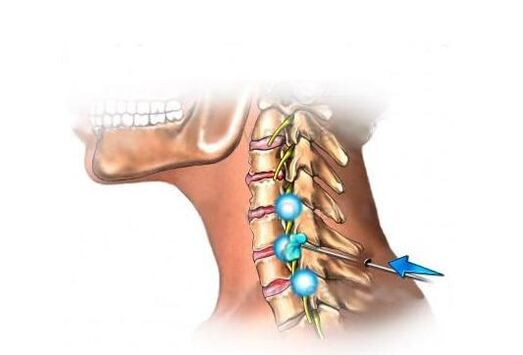 Behandlung der zervikalen Osteochondrose